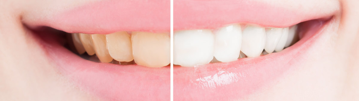 Tooth Whitening with Henry B. Bowman, DDS