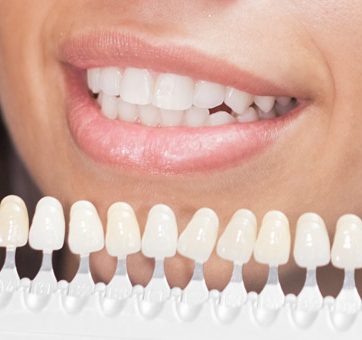How Porcelain Veneers Can Transform Your Smile